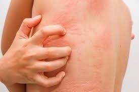 Best Allergy Treatment in Rajouri Garden