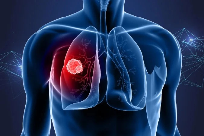 Best Lung Cancer in New Delhi
