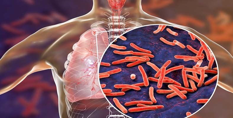 Best Tuberculosis Specialist in New Delhi