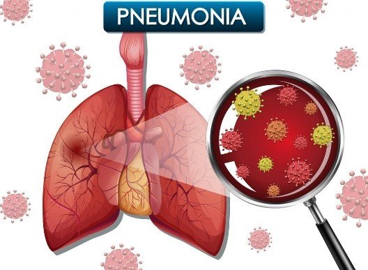 Pneumonia Treatment in Tilak Nagar